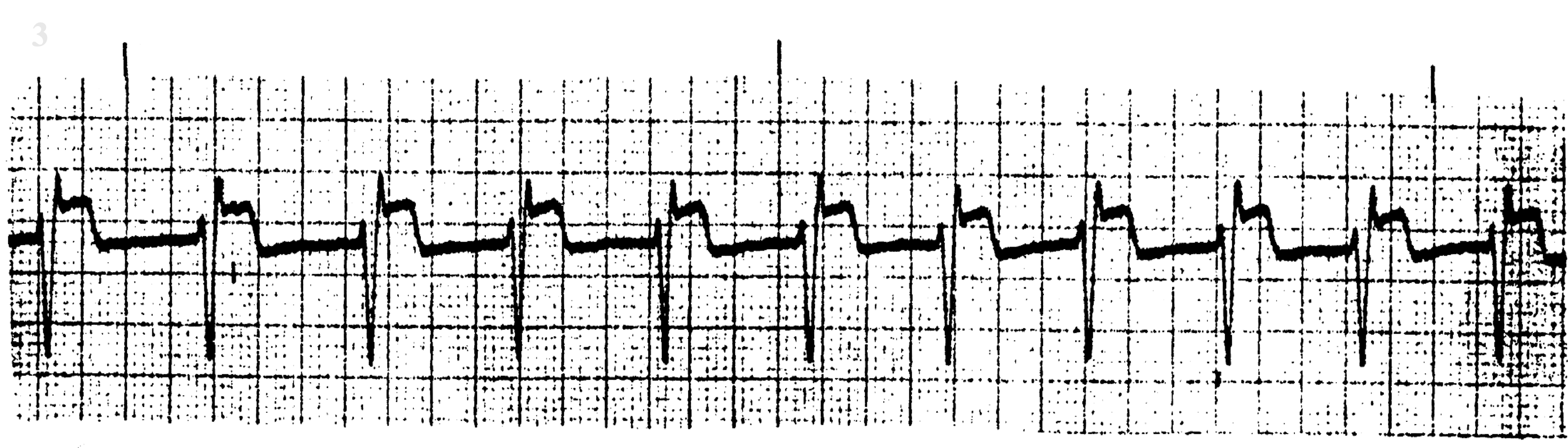 <p>What ECG is this? </p>