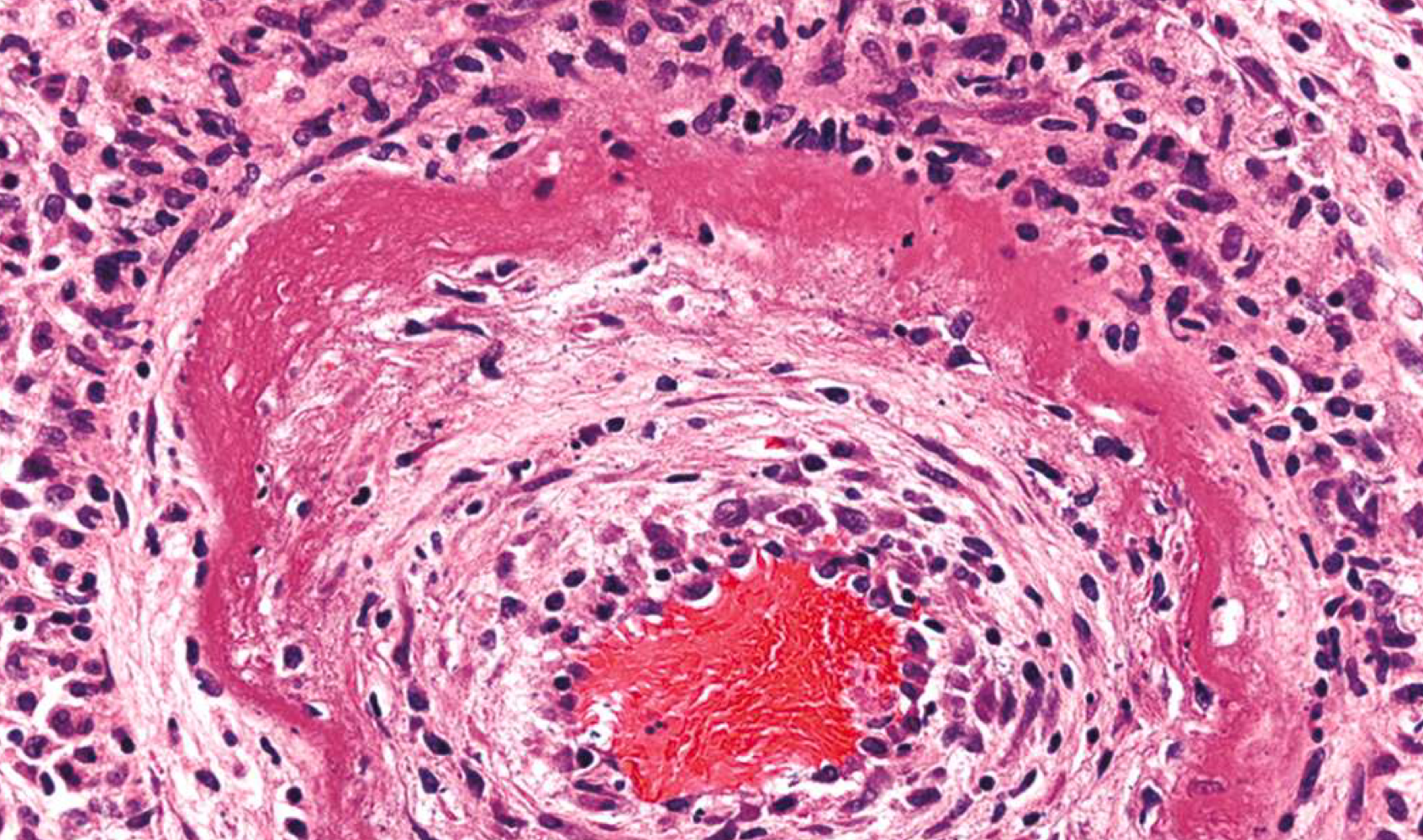 <p>eosinophilic deposits in wall of bv</p>