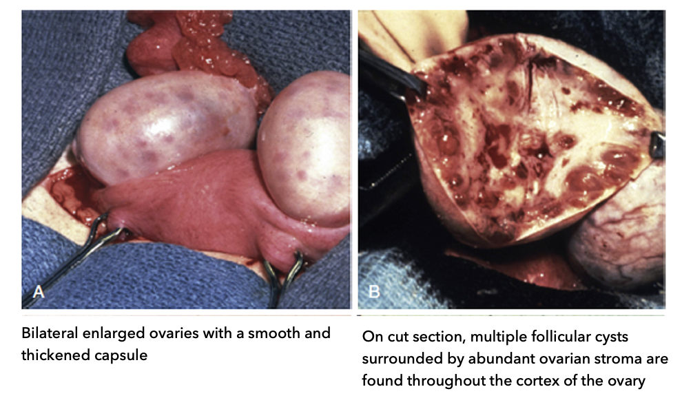 <ul><li><p><strong>A: External (gross) appearance:</strong></p><ul><li><p><strong>Bilateral enlarged ovaries</strong> (both ovaries bigger than healthy)</p></li><li><p><strong>Smooth, thickened capsule</strong> (outer layer is thicker than normal)</p></li></ul></li><li><p><strong>B: Cut section (internal structure):</strong></p><ul><li><p><strong>Multiple follicular cysts</strong> (arrested follicles)</p></li><li><p>Cysts located in <strong>cortex (outer region)</strong> → “ring” near edge</p></li><li><p>Surrounded by <strong>abundant ovarian stroma</strong> (supportive tissue)</p></li></ul></li><li><p><strong>Key idea:</strong></p><ul><li><p>Follicles accumulate at <strong>outer cortex</strong> instead of maturing → hallmark of PCOS</p></li></ul></li></ul><p></p>