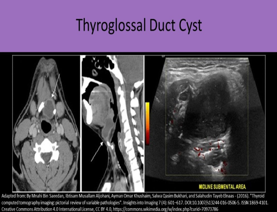 <p>A. thyroglossal duct cyst</p><p>Thyroglossal duct connects the thyroid to the pharynx and regresses after thyroid gland reaches its normal position in the neck. The duct can fail to regress completely leaving a cystic structure behind. The cyst usually forms high in neck, near midline. It is the most common congenital neck cyst.</p><p class="p1">Sonographically, the cyst appears as an anechoic structure anterior to the pharynx and superior to thyroid gland that has all qualities of simple cyst.</p>