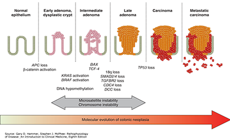 <ul><li><p>Progresses from normal epithelium to adenomas and eventually to invasive and metastatic carcinoma.</p></li><li><p>mutated APC gene (tumor suppressor gene)</p></li></ul><p></p><ul><li><p>Epithelial</p></li></ul><p></p>