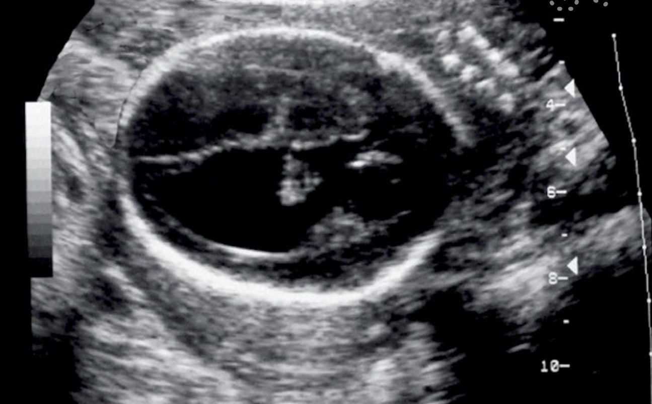 <p>What pathology is seen in this image?</p>