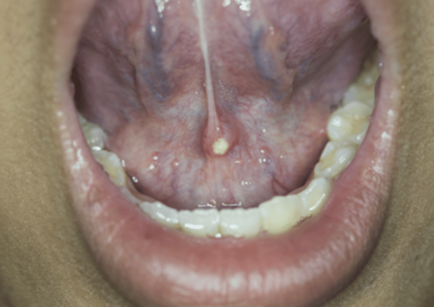 <p>B) affects most frequently the submandibular gland</p><p>EXPLANATION</p><p>Sialolithiasis affects most commonly the submandibular gland, and the resolution is the removal of the gland in most of the cases.</p>