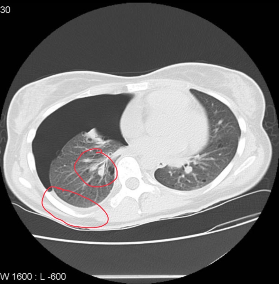 <p>CT of pt</p>