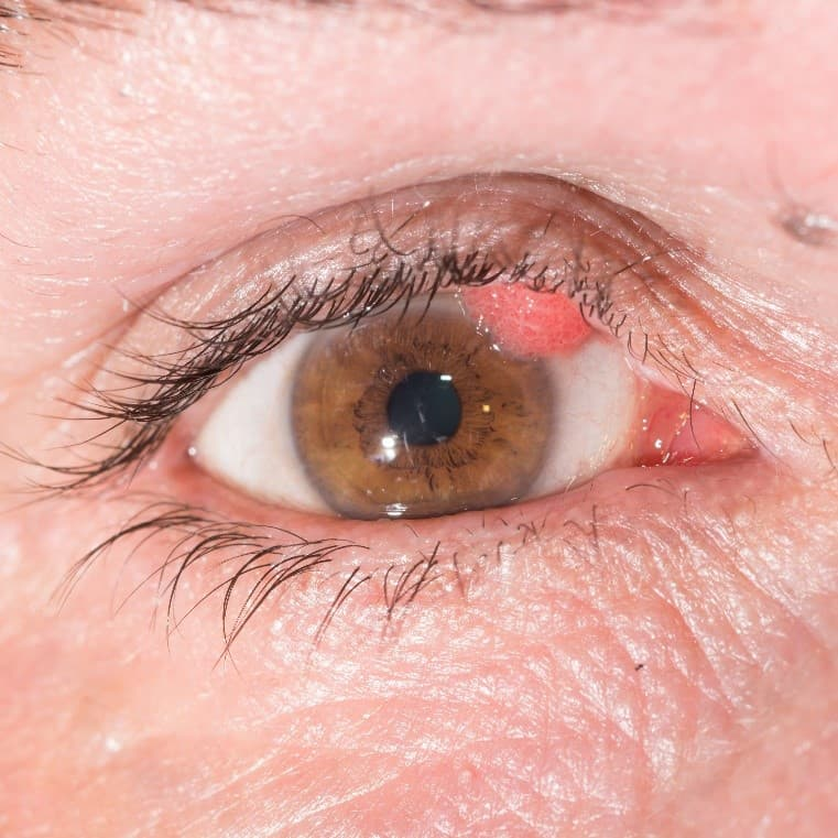<p>Es una hiperplasia benigna del epitelio escamoso de crecimiento lento, más prevalente en niños. Presenta hiperqueratosis y acantosis epitelial; se manifiesta en forma de pólipos pediculados o sésiles y no suele requerir tratamiento a menos que cause molestia visual</p>