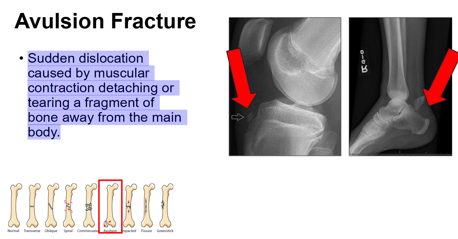 <p>Avulsion Fracture</p>