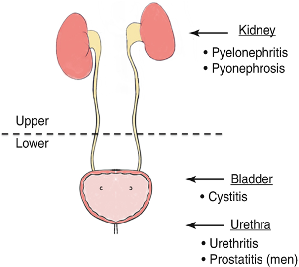 <ul><li><p>Occurs when a pathogen enters the urinary tract, remember this system is sterile above the urethra </p></li><li><p>Identified by location: upper or lower </p><ul><li><p>Upper UTIs include pyelonephritis, interstitial nephritis, and abscess (renal or perirenal) </p></li><li><p>Lower UTIs include cystitis (bladder), prostatitis (prostate), and urethritis (urethra) </p></li></ul></li><li><p>If not treated, can lead to AKI, CKD, or urosepsis</p></li><li><p>Accounts for over 8 million healthcare visits/year </p><ul><li><p>More common in females </p></li></ul></li><li><p>CAUTI is the most common healthcare-associated infections and cause of secondary bloodstream infections </p><ul><li><p>CAUTI is a UTI associated with indwelling urinary catheters </p></li><li><p>A UTI that occurs while the pt has an indwelling urinary catheter in place for more than 2 calendar days on the day that the infection was detected </p></li></ul></li></ul><p></p>