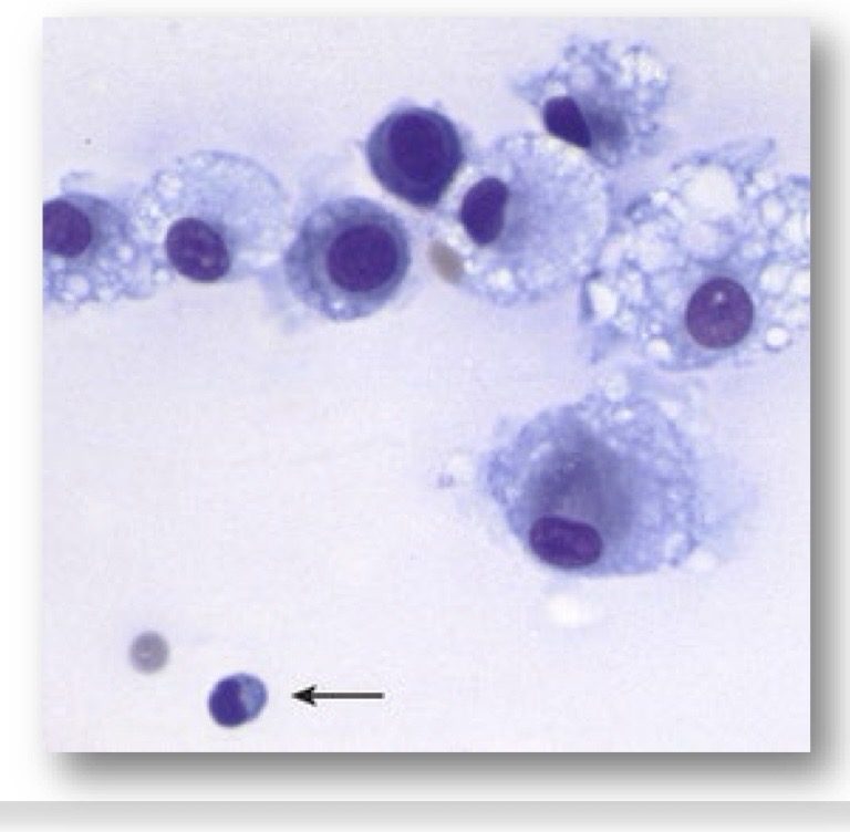 <p>is this cytology consistent with normal, inflammatory or noninflammatory joint disease?</p>