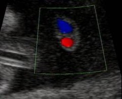 <p>Single umbilical artery (SUA) = one artery in the umbilical cord is missing (could be either the left or right artery), more frequently the left.</p>