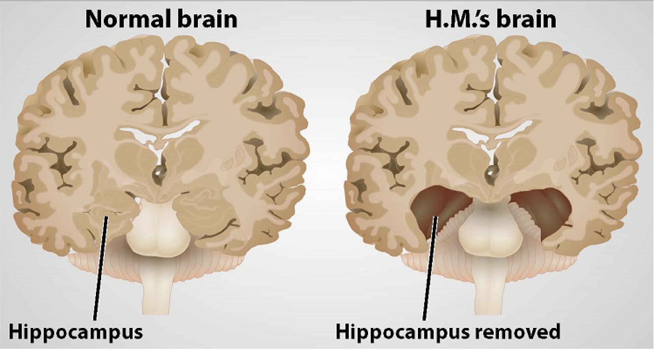 <p>Severe epilepsy lead to removal of his hippocampus, and damage to amygdala</p><p>Could not form new declarative memories</p><p>Fear conditioning was intact, but had no recollection of conditioning</p>