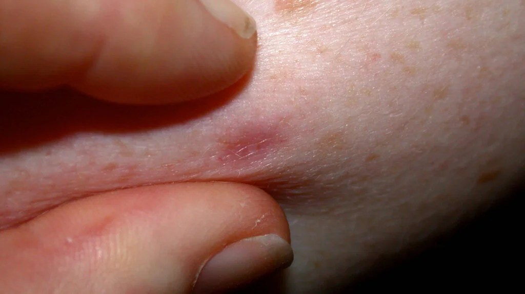 <p>The lesion dimples inward when the surrounding skin is pinched.</p>