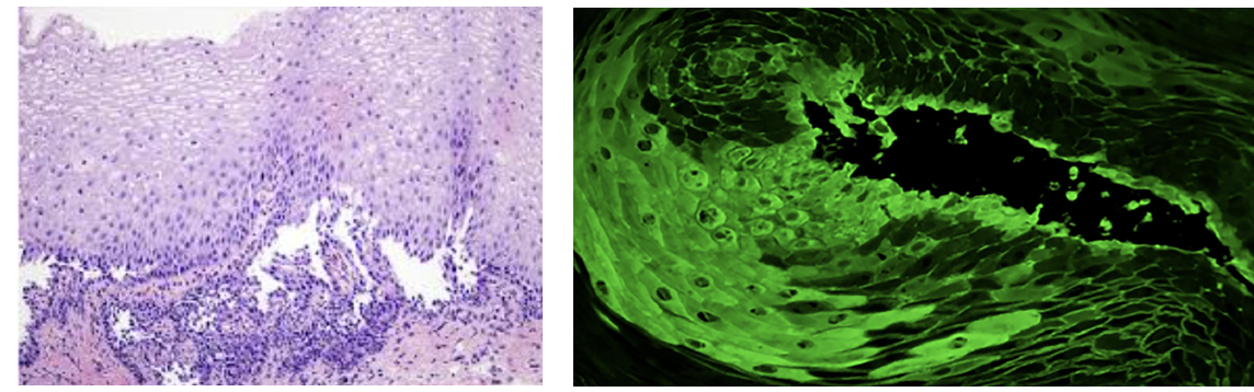 <p>Lésion bulleuse de l’oesophage</p><p>1) diagnostic </p><p>2) histologie</p><p>3) IFD</p>