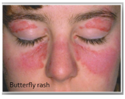 <ul><li><p><span style="background-color: transparent; font-family: "Times New Roman", serif;">Arthritis (90%)</span></p></li><li><p><span style="background-color: transparent; font-family: "Times New Roman", serif;">Vasculitis and rash (70-80%)</span></p></li><li><p><span style="background-color: transparent; font-family: "Times New Roman", serif;">Renal disease (40-50%)</span></p></li><li><p><span style="background-color: transparent; font-family: "Times New Roman", serif;">Anemia (50%)</span></p></li><li><p><span style="background-color: transparent; font-family: "Times New Roman", serif;">Cardiovascular disease (30-40%)</span></p></li><li><p><span style="background-color: transparent; font-family: "Times New Roman", serif;">Butterfly rash</span></p><ul><li><p><span style="background-color: transparent; font-family: "Times New Roman", serif;">Result of exposure to UVB radiation because of release of nuclear antigens from the skin</span></p></li></ul></li></ul><p></p>