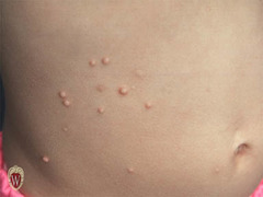 <p>A small, circumscribed lesion usually less than 1 cm in diameter. It is elevated or protrudes above the surface of normal surrounding tissues.</p>