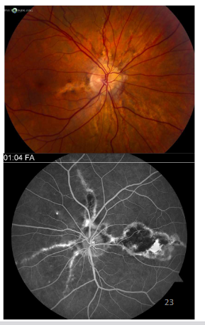 <p>Name this condition</p>