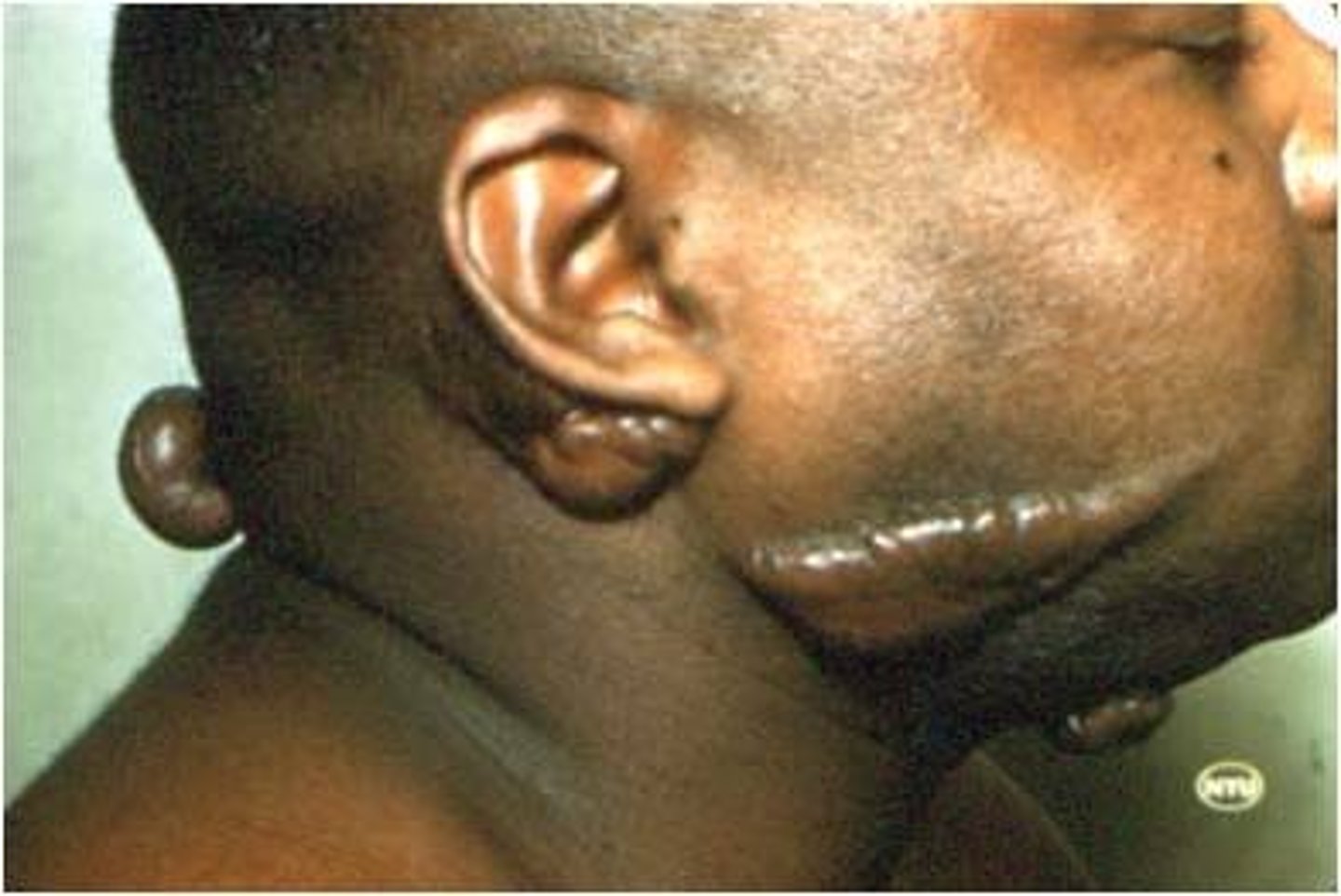 <p>raised scar</p>