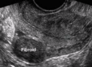 <p><span style="background-color: transparent;">Where is this fibroid located in the uterus?</span></p><p><span style="background-color: transparent;">a. Anterior&nbsp;</span></p><p><span style="background-color: transparent;">b. Posterior&nbsp;</span></p><p><span style="background-color: transparent;">c. Cervical&nbsp;</span></p><p><span style="background-color: transparent;">d. Fundal</span></p>
