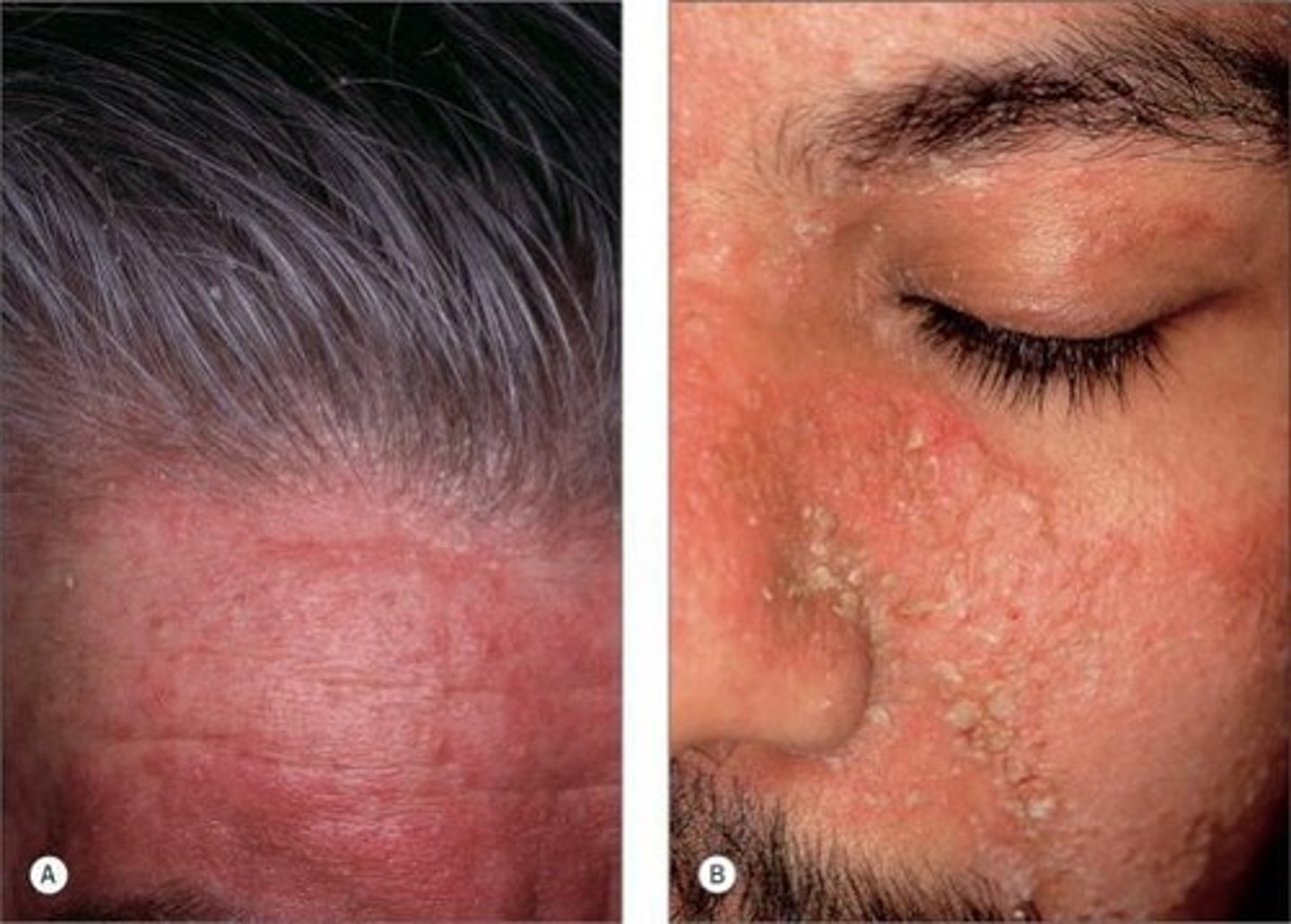 <p>Skin condition caused by an inflammation of the sebaceous glands. It is often characterized by redness, dry or oily scaling, crusting, and itchiness.</p>