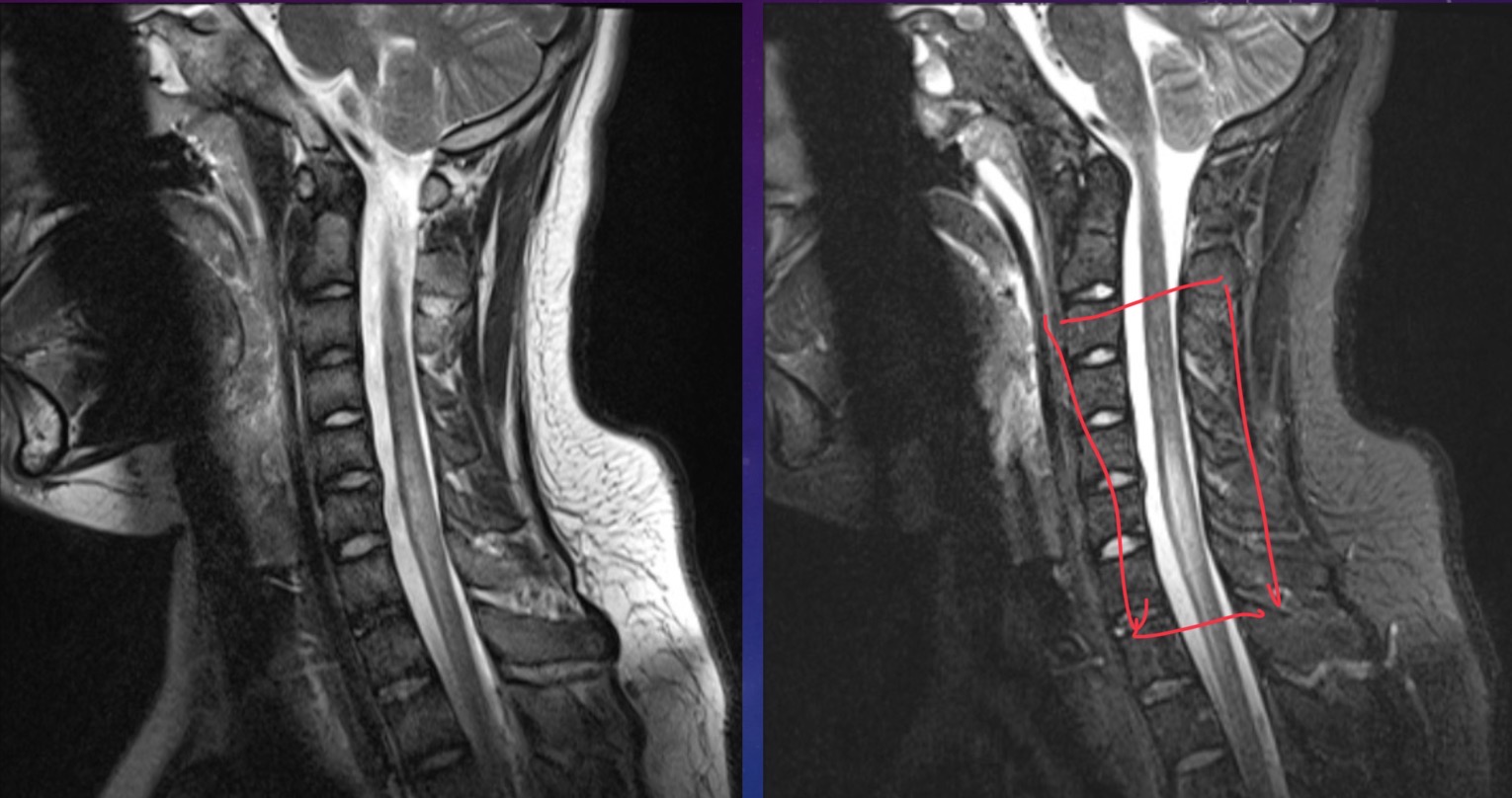 <p>12-year-old male is a secondary school student with acute onset tetraparesis. He has a rapid ascending paralysis with neuromuscular weakness with brisk reflexes. Patient also has cervical myelitis</p>