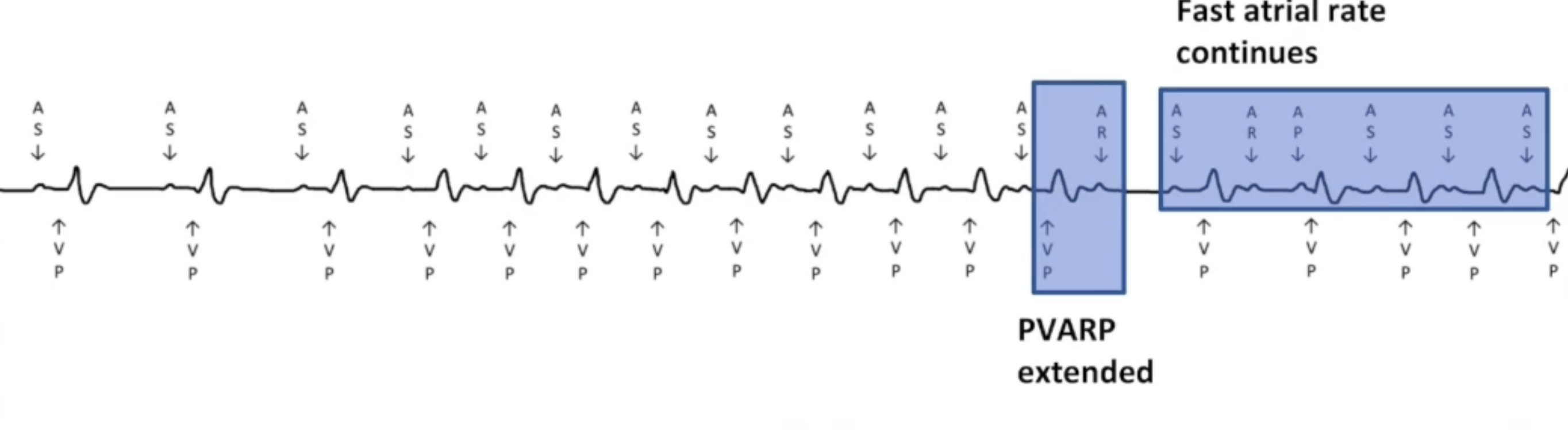 <ul><li><p>Sinus tachycardia: program MTR higher</p></li><li><p>Atrial flutter: blanked flutter search</p></li></ul><p></p>