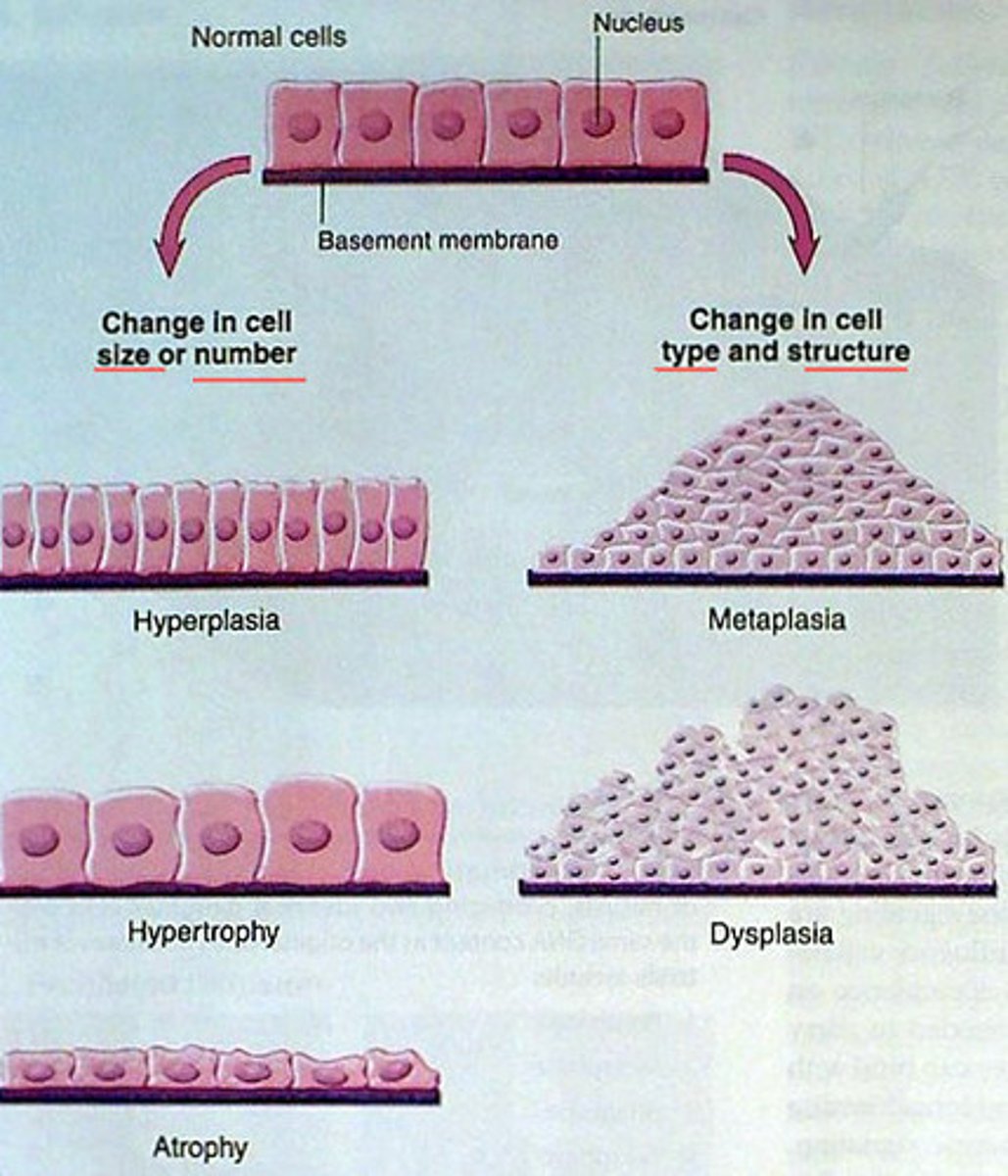 <p>refers to cells that are undifferentiated with variable nuclear and cell structures and numerous mitotic figures. Ex: malignant tumors</p>