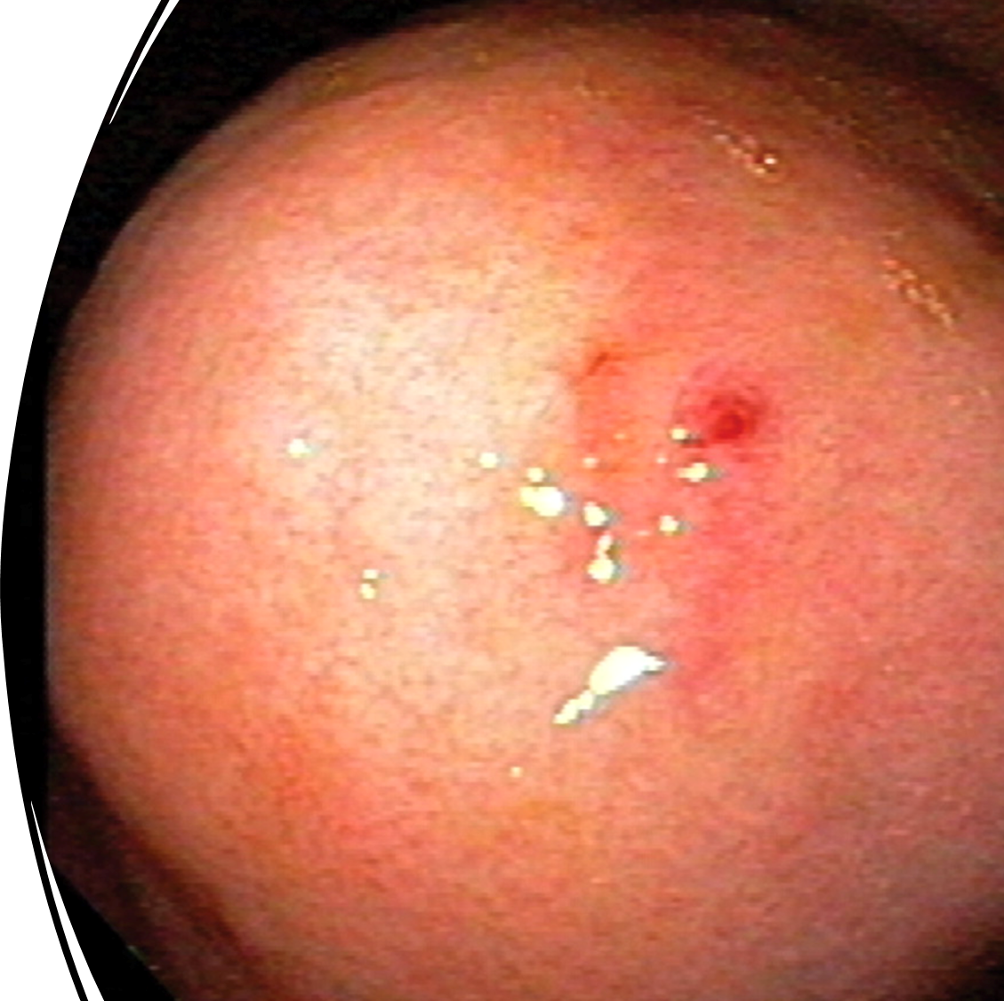 <p>large submucosal artery</p><p>proximal stomach</p><p>intermittent painless massive bleeding</p><p>hard to ID</p>