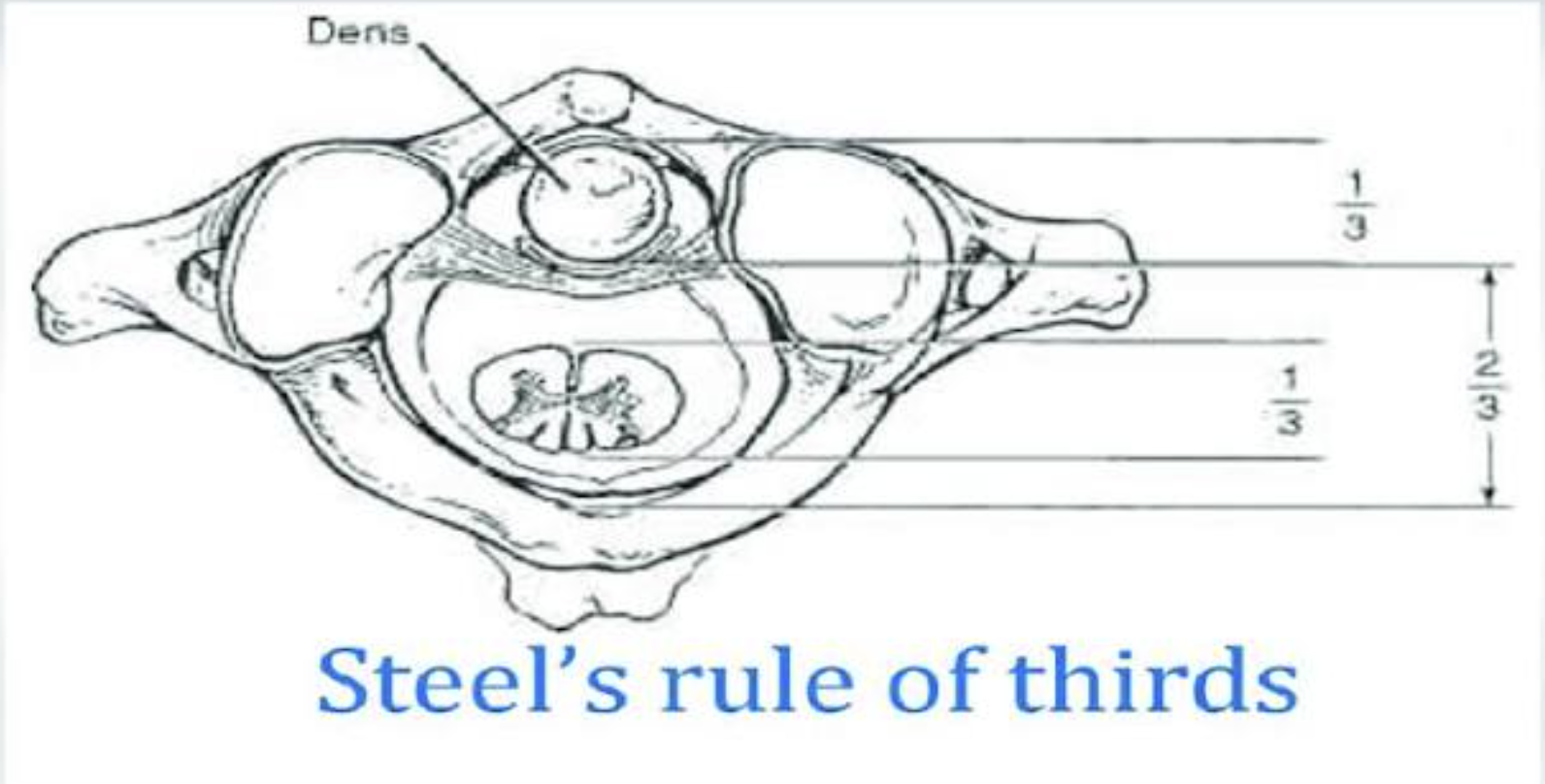 <p>Steele’s Rule of Thirds (divides ring of atlas/C1 into thirds)</p>
