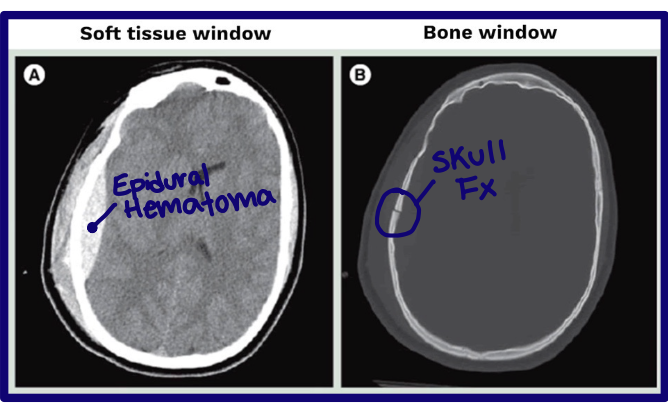<ul><li><p>Bone window and soft tissue window</p></li><li><p>Will show the ranges of raiodensities based on chosen tissue window</p></li></ul><p></p>