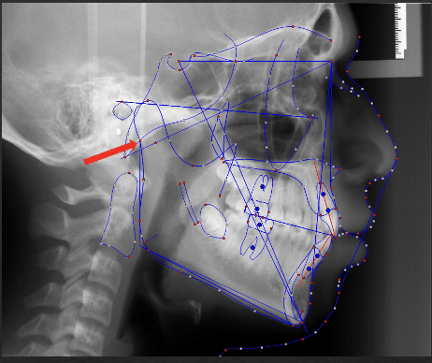 <p>which anatomical landmark:</p><p>- Intersection of the mandible with the temporal bone</p><p>- Not an anatomic structure</p>