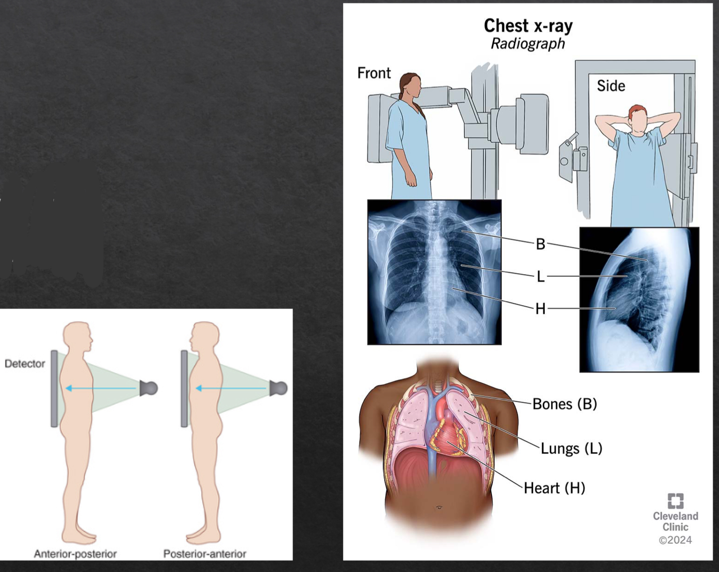 <ul><li><p>frontal</p><ul><li><p>posteroanterior (PA)</p></li><li><p>anteroposterior (AP)</p></li></ul></li><li><p>lateral</p><ul><li><p>left lateral</p></li></ul></li></ul><p></p>