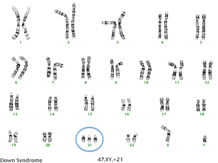 <p>If a gamete with an extra chromosome is fertilised by a normal gamete, the zygote will show trisomy:</p><ul><li><p>three chromosome copies, instead of two (e.g. Down’s syndrome, which is caused by trisomy 21)</p></li></ul><p></p>