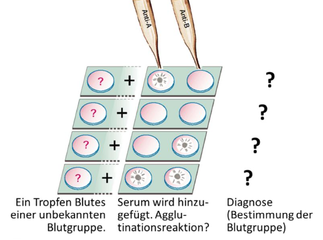 <ul><li><p>Blutgruppensysteme = Eigenschaften der Membranen, nicht nur der Membranen der Zellen im Blutkreislauf, sondern aller Membranen</p></li><li><p>Auf Membranen sind Antigene (Antigen = Abk. von Antibody-Generator)</p></li><li><p>Im Plasma sind die Antikörper (bei Blutgruppe A: Anti-B, bei B: Anti-A, bei AB: keine, bei 0: Anti-A und Anti-B)</p></li><li><p>AB0-System</p></li><li><p>Rh-System</p></li><li><p>Es gibt >100 Blutgruppensysteme, die meisten sind von forensischem Interesse</p></li><li><p>(Vaterschaftsuntersuchungen, Kriminalfälle etc. Grund: Antigene des z.B., AB0-Systems finden sich auch in anderen Körperflüssigkeiten wie Speichel, Sperma, Schweiß, Magensaft etc.)</p></li><li><p>Komplikationen: Wenn Antigen A mit Antikörper Anti-A in Berührung kommt: Agglutinierung der Erys (=Zusammenballung und Verklebung), Anschließend Hämolyse, da die Zellmembranen der großen Erythrozyten-Agglutinate im Blutstrom zerreißen können. Daher extrem wichtig für Bluttransfusion.</p></li><li><p>Antikörper = „Agglutinine“, Antigene = „Agglutinogene“</p></li><li><p>&nbsp;Transfusionszwischenfälle:</p><ul><li><p>Schwer: Empfängerplasma enthält Antikörper gegen Spendererythrozyten</p></li><li><p>Weniger schwer: Spenderplasma enthält Antikörper gegen Empfängererythrozyten (Grund: Antikörper werden in der Blutbahn des Empfängers verdünnt)</p></li></ul></li><li><p>Folie: Blutgruppentest</p><ul><li><p>Methode: unbekanntes Blut (?) wird mit drei Seren vermischt: Anti-A, Anti-B und Anti-A + Anti-B</p></li><li><p>Wo gleiche Buchstaben aufeinander treffen, geschieht eine Agglutination</p></li><li><p>Test ist redundant, aber sicherer.</p></li></ul></li></ul><p><span>Blutspende</span><br></p><ul><li><p>Major-Test: Empfängerserum + Spendererythrozyten</p></li><li><p>Minor-Test: Spenderserum + Empfängererythrozyten</p></li><li><p>Häufigkeit in der Bevölkerung ist ortsabhängig</p></li><li><p>Weltweit im Mittel (ca.): 0 (41%), A (31%), B (22%), AB (6%)</p></li><li><p>In Deutschland (ca.): 0 (41%), A (43%), B (11%), AB (5%)</p></li></ul><p></p>