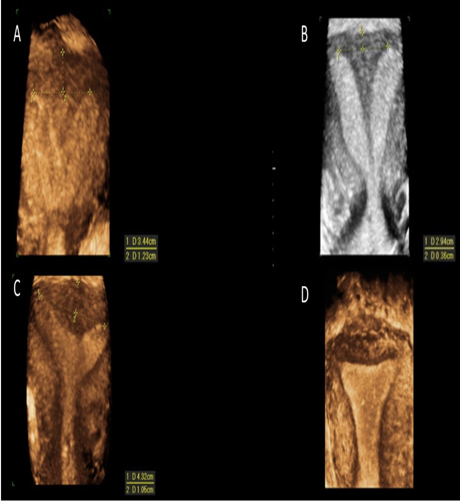 <p>Which of the images demonstrates a subseptate uterus?</p><p>A</p><p>B</p><p>C</p><p>D</p>