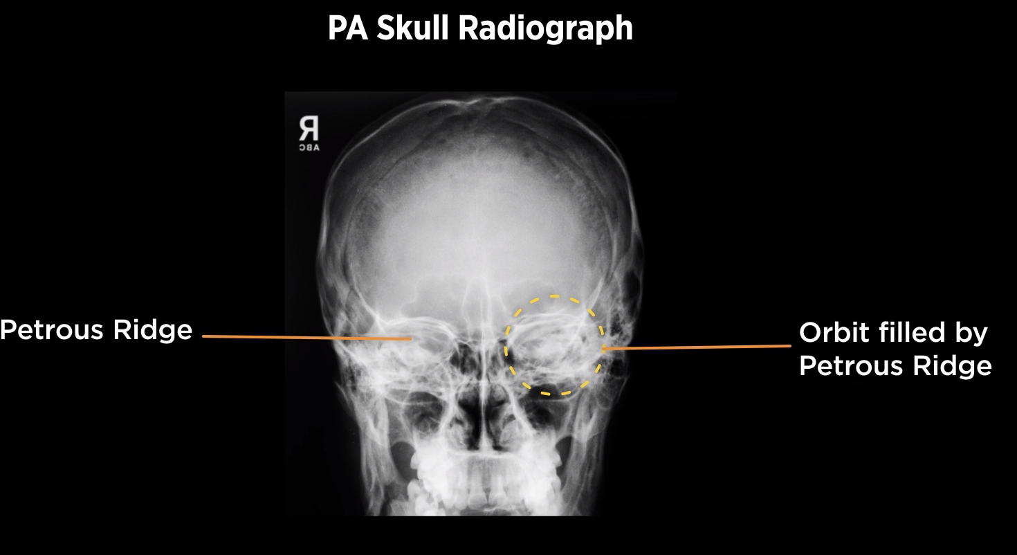 <p>PA Skull</p>