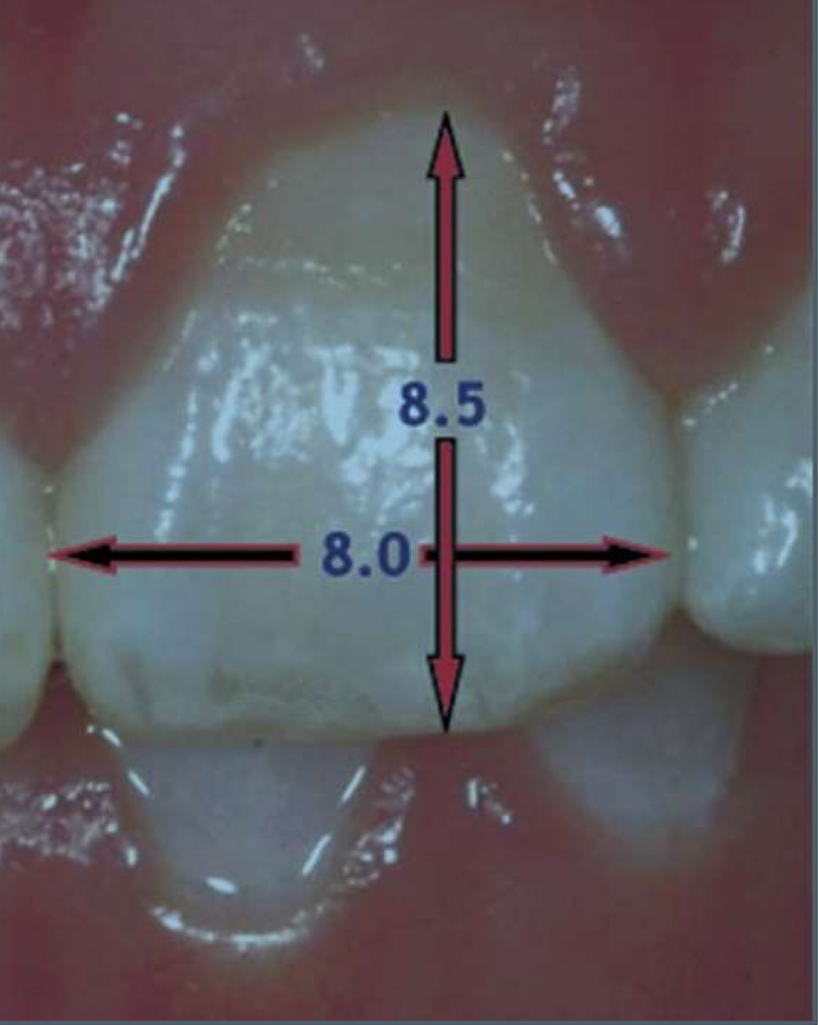 <p>is this upper left central incisor too short or too wide?</p>