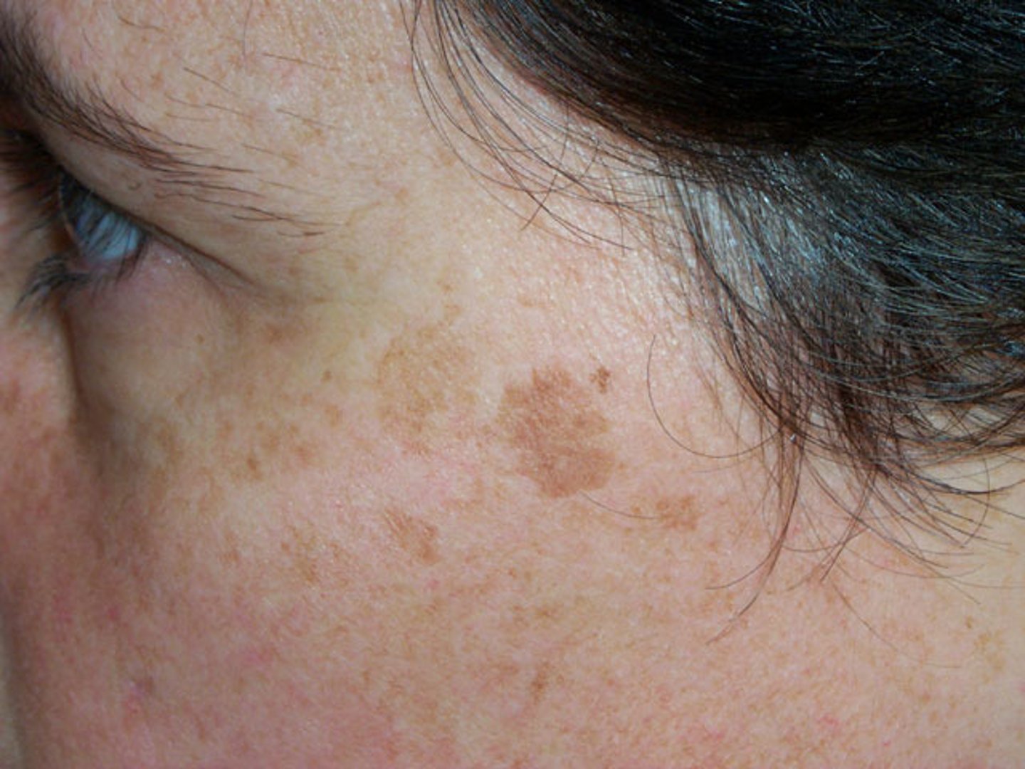 <p>freckle</p>