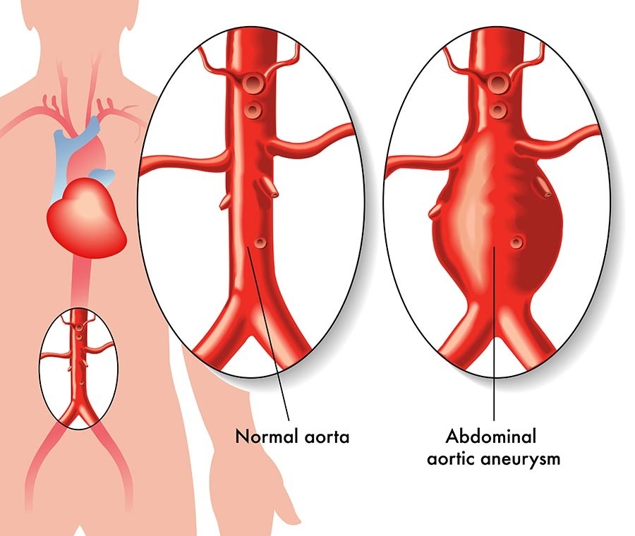 <p><strong>Aneurysm </strong></p>