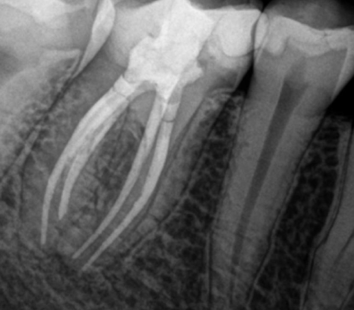 <p>What % of mandibular molars have 2 canals, and 2 foramina for their distal root?</p>