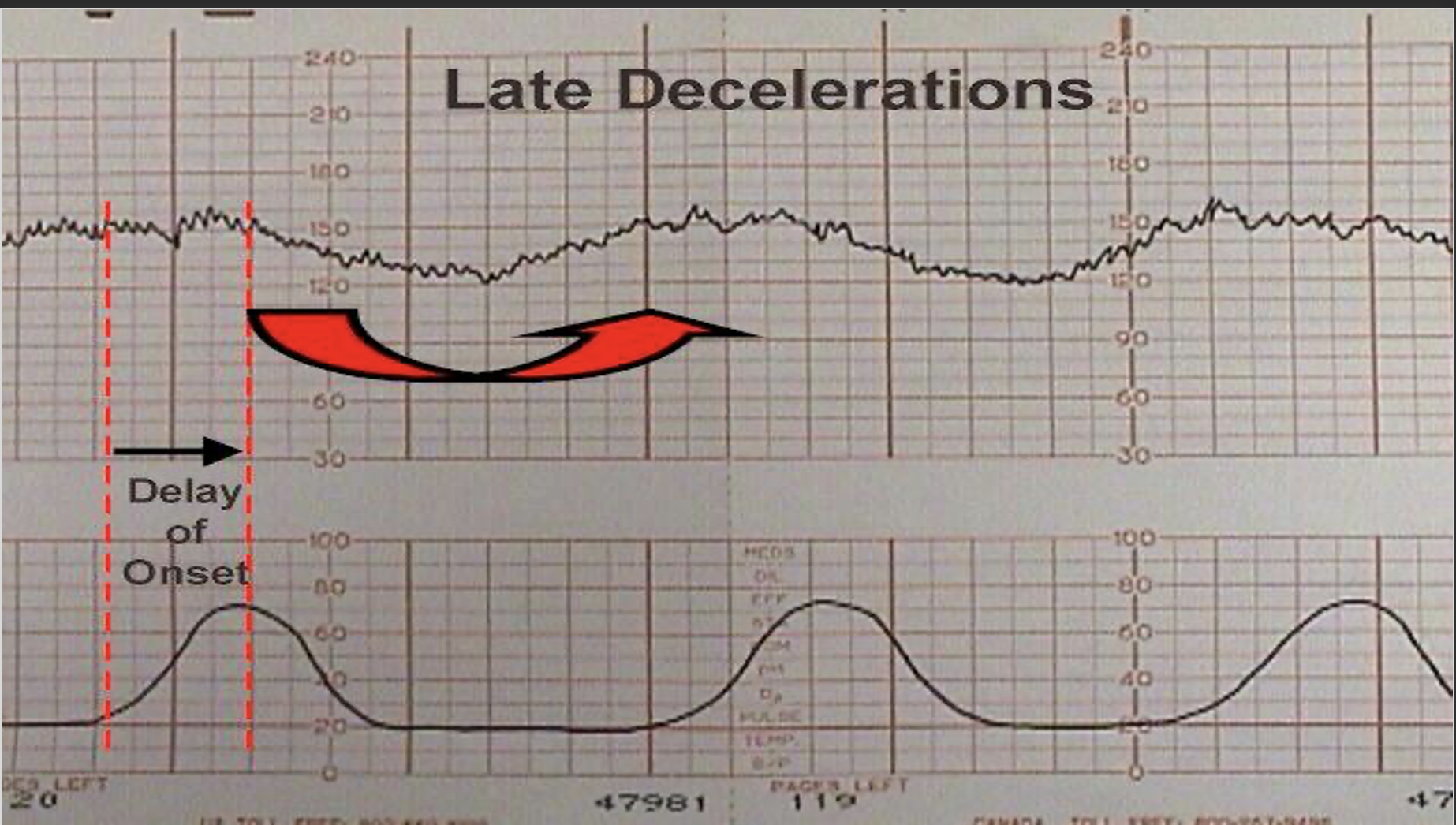 <p>Late Decelerations</p>