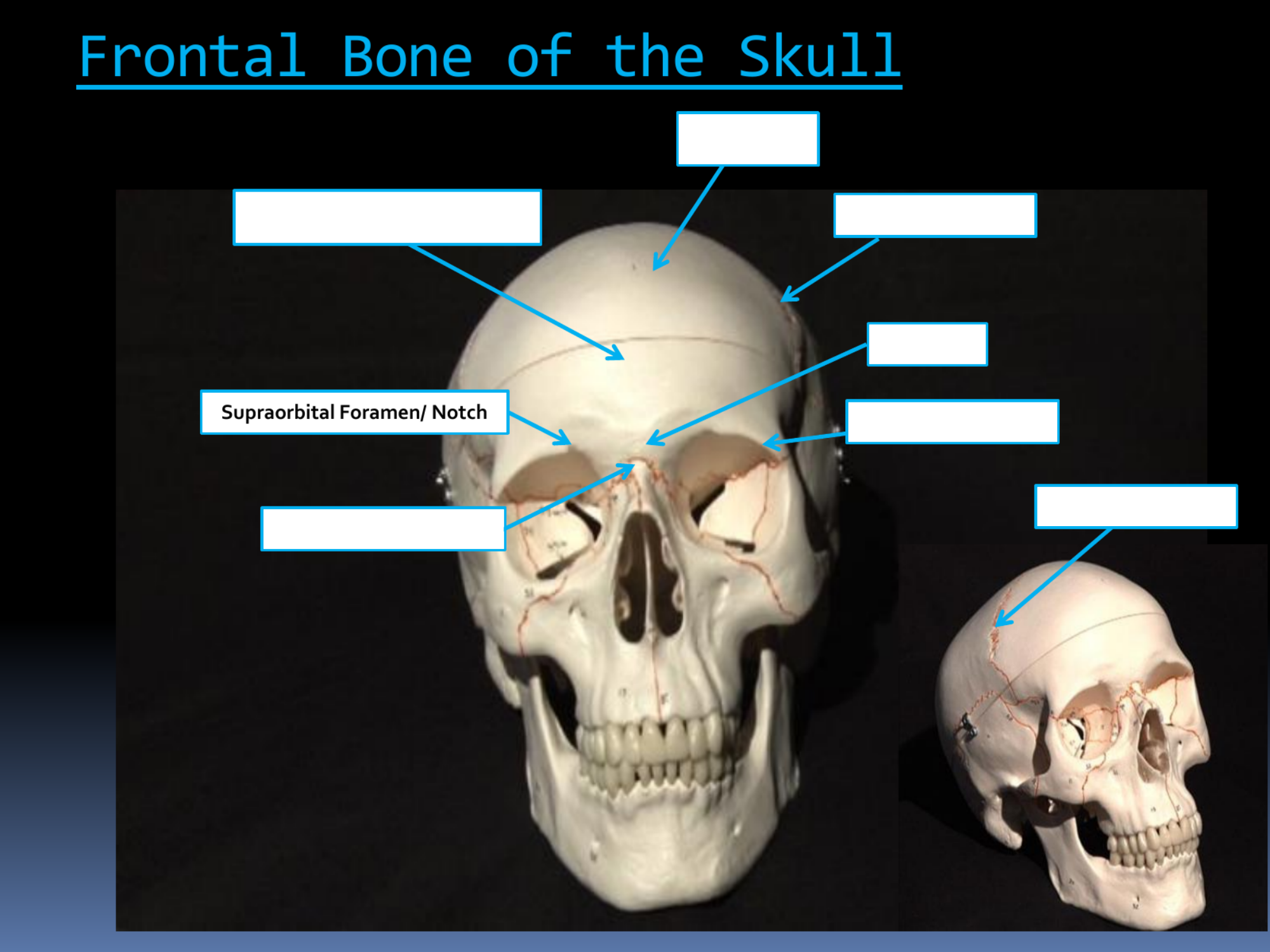 <p>Supraorbital Foramen/ Notch</p>