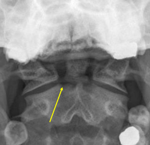 <p>Odontoid Fx</p>