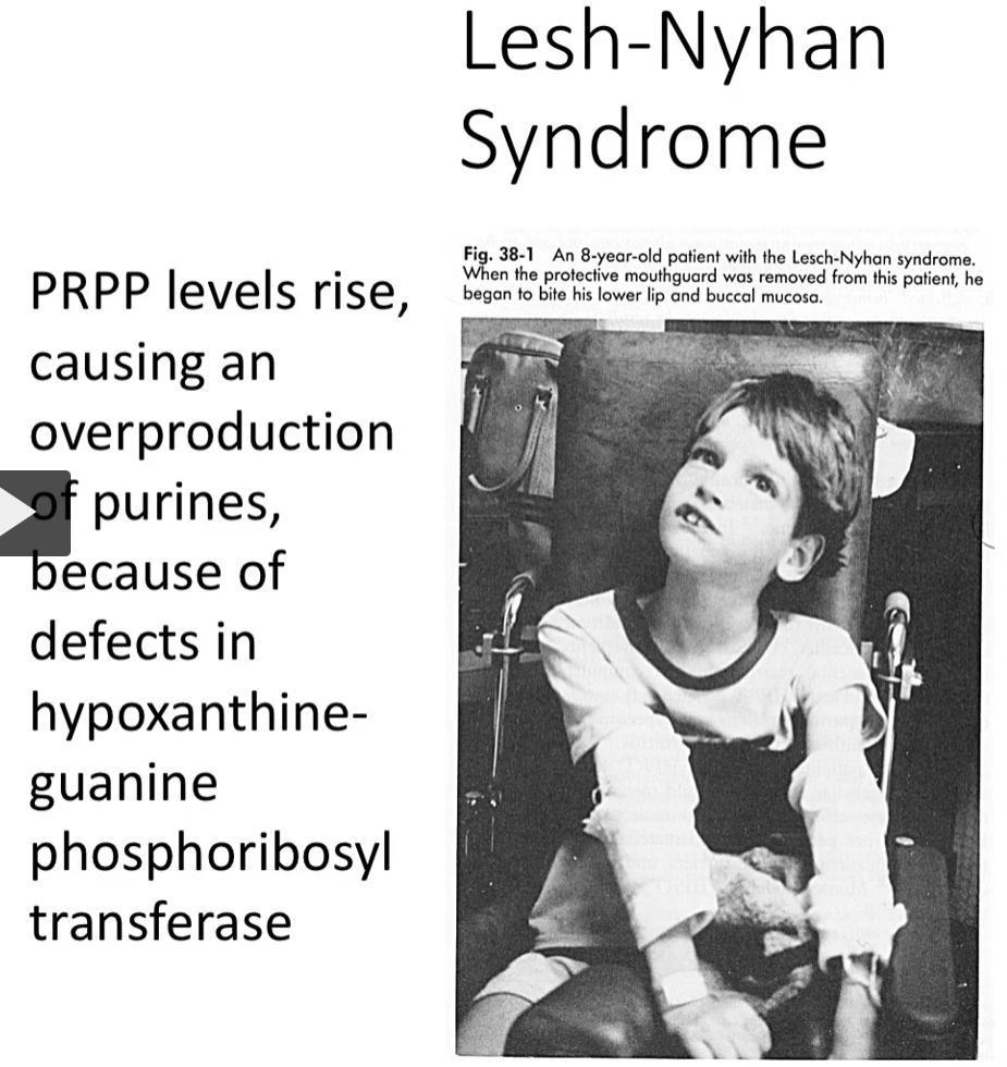 <p>defects in hypoxanthine-guanine phospho ribosyl transferase</p>