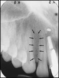 <p>lateral fossa</p>