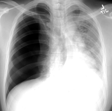 <p>24-year-old man with sudden, worsening right-sided chest pain and dyspnea. Vital signs are normal. Chest x-ray is below. What is the next step in management?<br></p>
