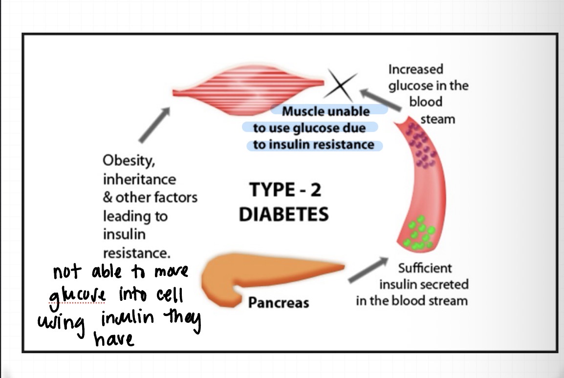 <ul><li><p>not able to move glucose into the cell using the insulin they have </p></li><li><p>obesity and other factors that lead to insulin resistance </p></li></ul><p></p>
