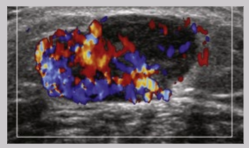 <ul><li><p><span style="background-color: transparent;">Contusion/hematoma/tear</span></p></li><li><p><span style="background-color: transparent;">Masses&nbsp;</span></p></li></ul><p></p>