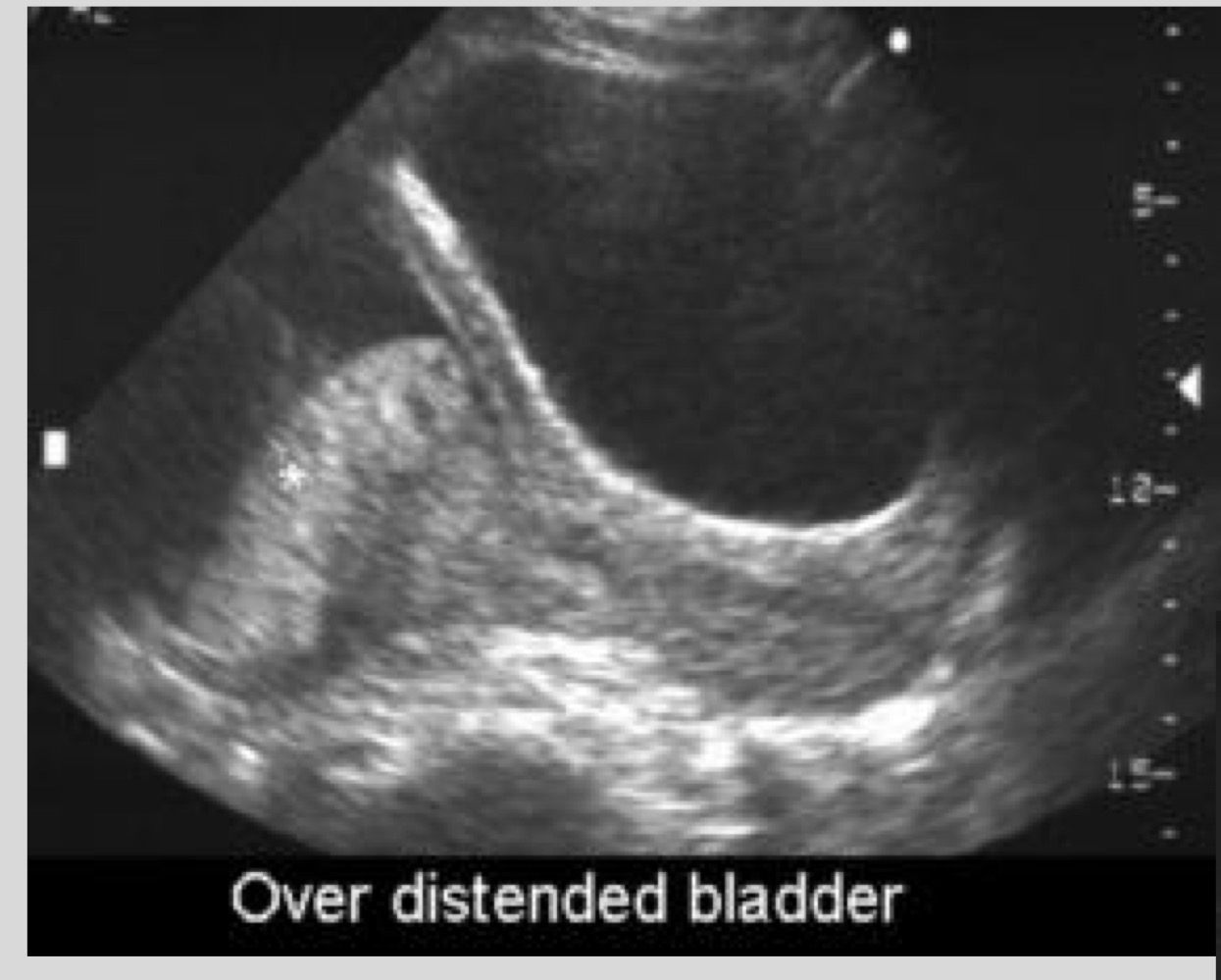 <p>Apparent previa caused by lower uterine segment contraction</p>