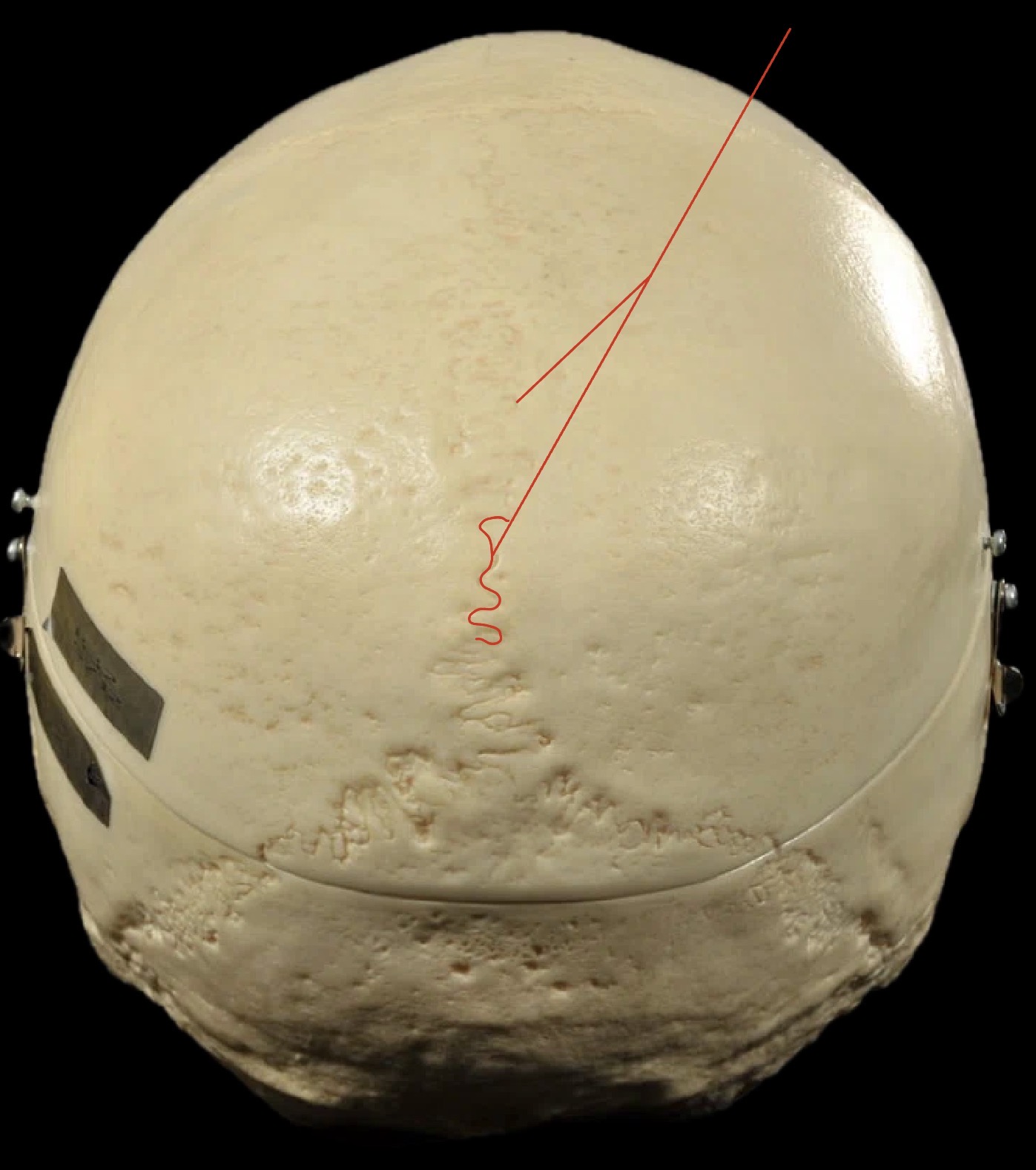 <p>What suture is this?</p>
