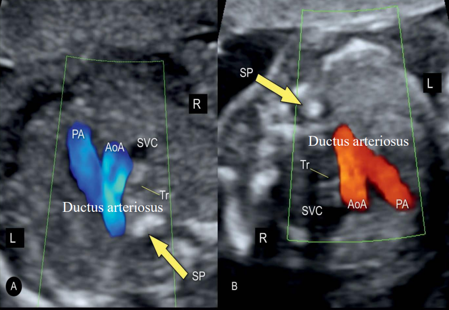 <ul><li><p><span style="background-color: transparent;">From pulmonary artery into descending aorta</span></p></li><li><p><span style="background-color: transparent;">Seals within 24 hrs after birth</span></p></li></ul><p></p>