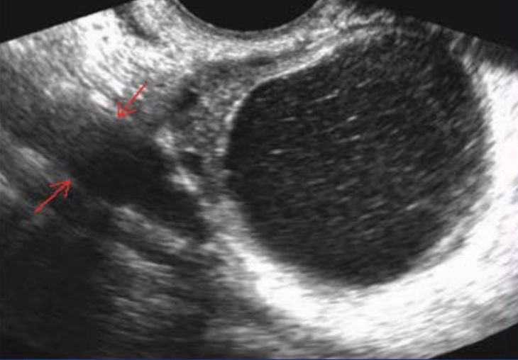 <p>What is the structure the arrows are pointing to?</p><p>a. Ovary</p><p>b. Iliac artery</p><p>c. Psoas muscle</p><p>d. Fallopian tube</p>